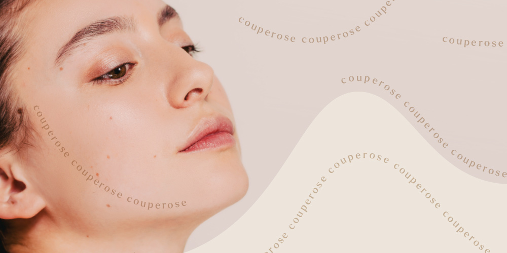 Vaatjes in je gezicht: hoe ontstaat couperose en wat kun je ertegen doen?